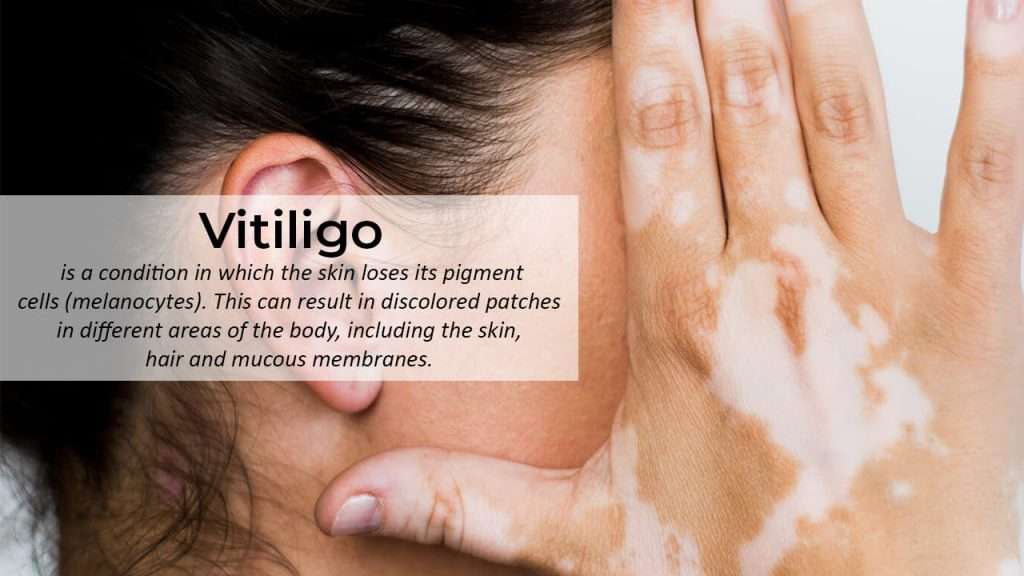 Vitiligo slider 4