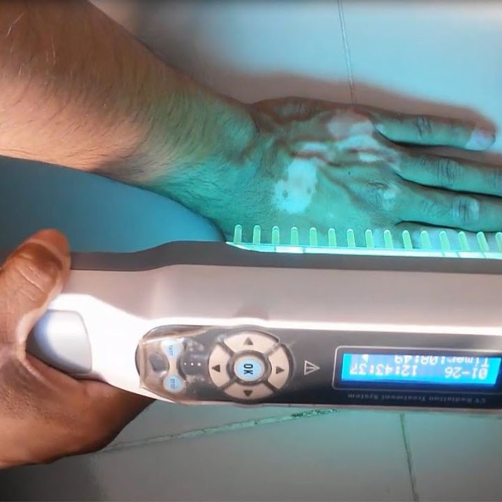 Lighttherapy For Vitiligo Lighttherapy For Vitiligo