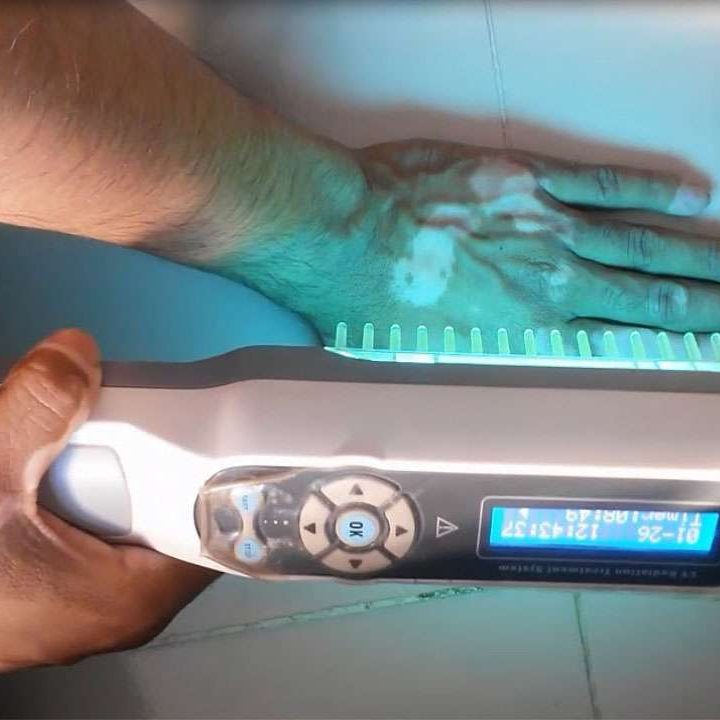 Lighttherapy For Vitiligo