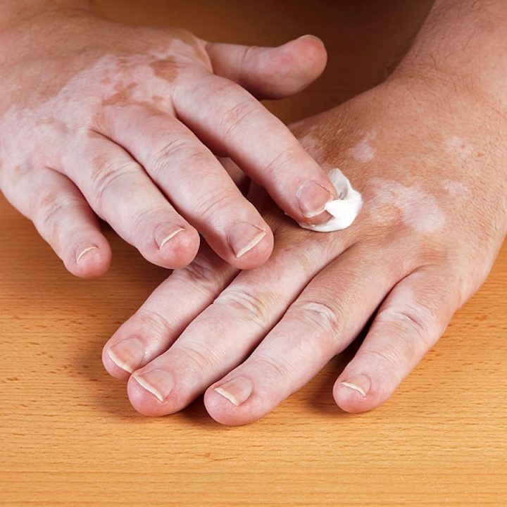 Medical Treatment Of Vitiligo