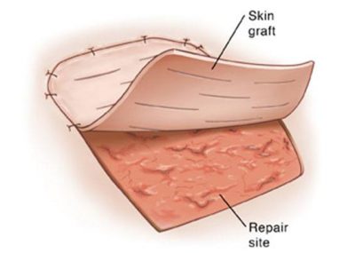 Skin-Grafting Skin-Grafting