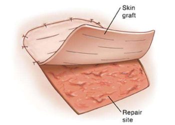 Skin-Grafting