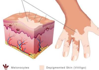 vitiligo-treatment-creams-400x400
